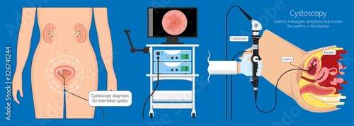 Cystoscopy diagnose bladder diseases and conditions exam treat benign prostatic hyperplasia BPH painful urology urethritis endoscopy urination endoscopic