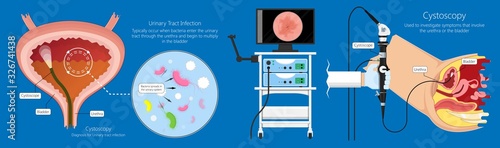 Cystoscopy diagnose bladder diseases and conditions exam treat benign prostatic hyperplasia BPH painful urology urethritis endoscopy urination endoscopic