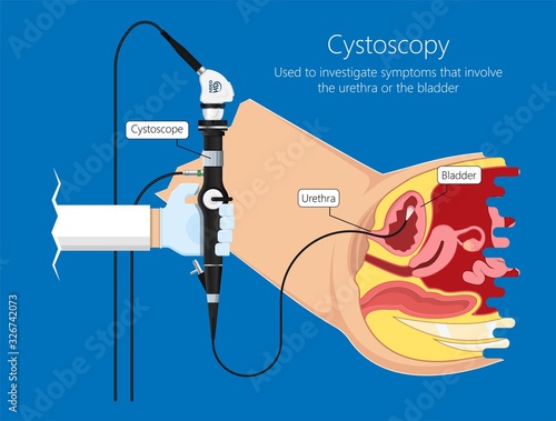 Cystoscopy diagnose bladder diseases and conditions exam treat benign prostatic hyperplasia BPH painful urology urethritis endoscopy urination endoscopic