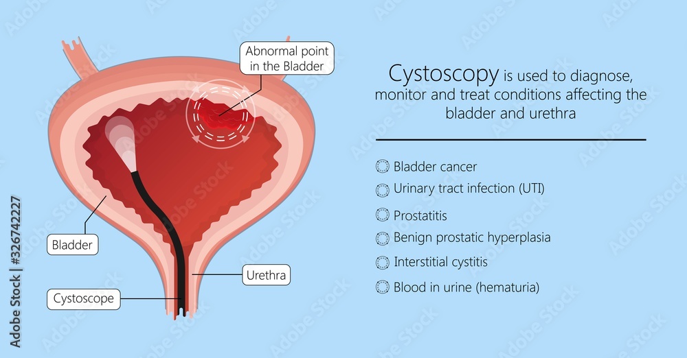 Cystoscopy diagnose bladder diseases and conditions exam treat benign
