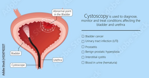 Cystoscopy diagnose bladder diseases and conditions exam treat benign prostatic hyperplasia BPH painful urology urethritis endoscopy urination endoscopic