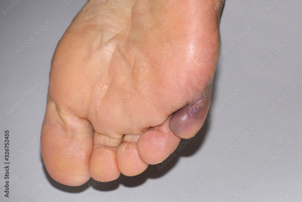 Fototapeta premium Gebrochener kleiner Zeh rechts von unten