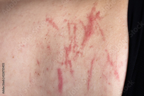 Skin irritation caused by excessive scratching of the itch photo