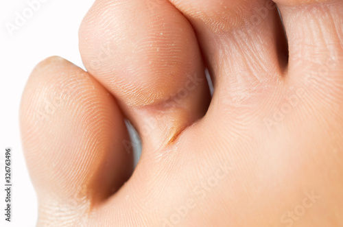 Close up foot of a woman with dry skin and a crack in her finger