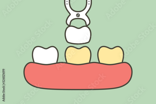 dental veneers installation procedure for tooth whiten - teeth cartoon vector flat style