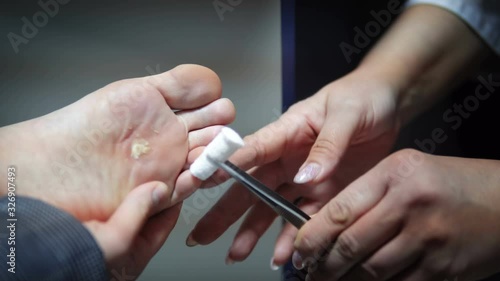 Doctor burns and freezes roots on the patient's foot that is infected with corn photo