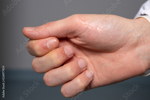Keloid on the palm of a boy's hand that developed following the scar of a surgical operation