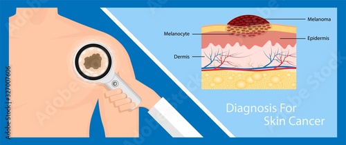 Skin cancer treatment diagnosis medical patient screening