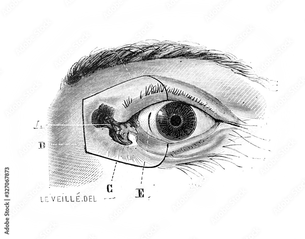 Eye cancer in the old book D'Anatomie Chirurgicale, by B. Anger, 1869