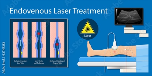 endovenous laser treatment CVD treat ELT legs inject EVLT varicose veins Radiofrequency Ablation RFA	