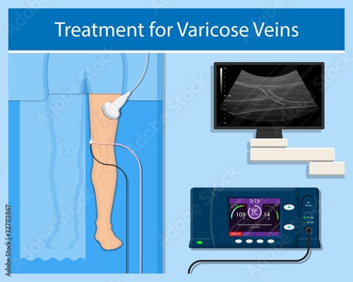 endovenous laser treatment CVD treat ELT legs inject EVLT varicose veins Radiofrequency Ablation RFA	