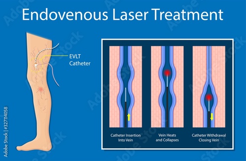 endovenous laser treatment CVD treat ELT legs inject EVLT varicose veins Radiofrequency Ablation RFA	