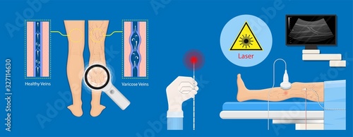 endovenous laser treatment CVD treat ELT legs inject EVLT varicose veins Radiofrequency Ablation RFA	