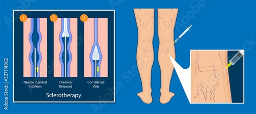 endovenous laser treatment CVD treat ELT legs inject EVLT varicose veins Radiofrequency Ablation RFA	