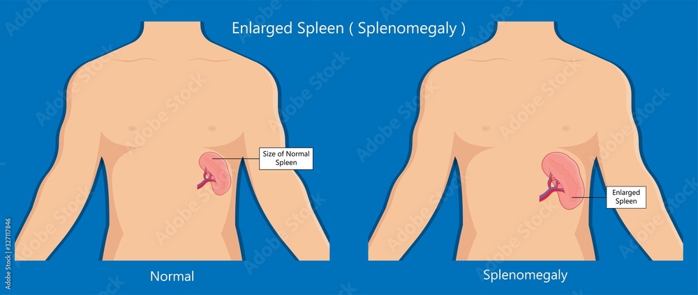 Enlarged Spleen Splenomegaly White Blood Cells Viral Infection Cancer enlarged-spleen-splenomegaly-white-blood-cells-viral-infection-cancer