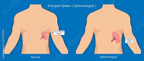 Enlarged spleen splenomegaly white blood cells Viral infection cancer Inflammatory enlargement