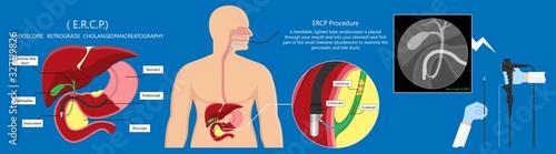 Endoscopic Retrograde Cholangiopancreatography ERCP diagnose treat device bile duct X-rays pancreatic removal material study surgery Tumor cancer infection diagnostic abdominal MRI inject