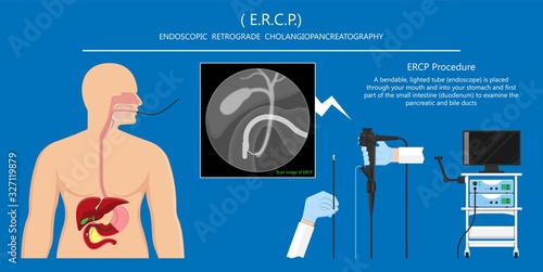 Endoscopic Retrograde Cholangiopancreatography ERCP diagnose treat device bile duct X-rays pancreatic removal material study surgery Tumor cancer infection diagnostic abdominal MRI inject