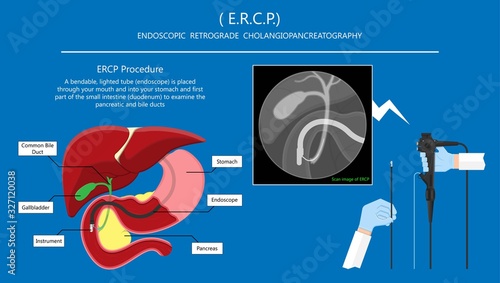 Endoscopic Retrograde Cholangiopancreatography ERCP diagnose treat device bile duct X-rays pancreatic removal material study surgery Tumor cancer infection diagnostic abdominal MRI inject