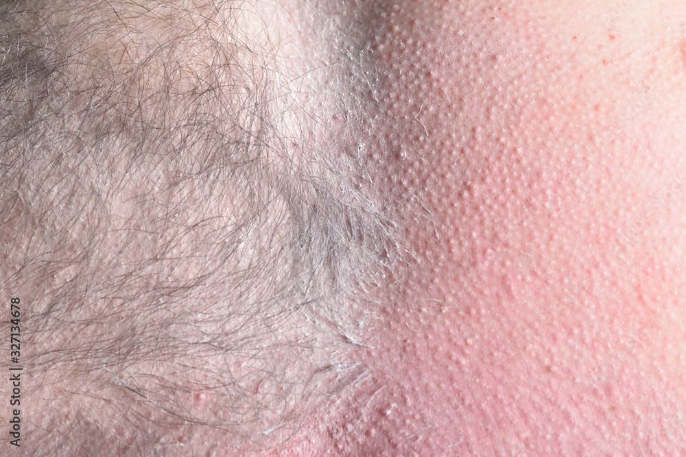 Fototapeta premium Male depilation. Half of male chest without hair after waxing. Close-up