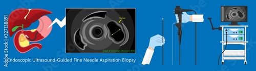 medical endoscopic ultrasound EUS cancer tumor diagnose FNA abdominal test CT scan MRI colon stomach gastric rectal organs examine rectum Acute abnormal esophageal needle pain ulcer pancreas nodule