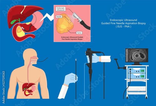medical endoscopic ultrasound EUS cancer tumor diagnose FNA abdominal test CT scan MRI colon stomach gastric rectal organs examine rectum Acute abnormal esophageal needle pain ulcer pancreas nodule