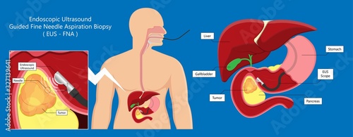 medical endoscopic ultrasound EUS cancer tumor diagnose FNA abdominal test CT scan MRI colon stomach gastric rectal organs examine rectum Acute abnormal esophageal needle pain ulcer pancreas nodule
