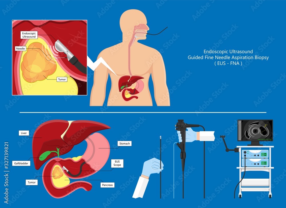 medical endoscopic ultrasound EUS cancer tumor diagnose FNA abdominal