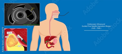 medical endoscopic ultrasound EUS cancer tumor diagnose FNA abdominal test CT scan MRI colon stomach gastric rectal organs examine rectum Acute abnormal esophageal needle pain ulcer pancreas nodule