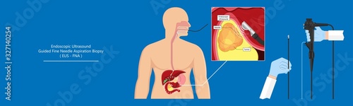 medical endoscopic ultrasound EUS cancer tumor diagnose FNA abdominal test CT scan MRI colon stomach gastric rectal organs examine rectum Acute abnormal esophageal needle pain ulcer pancreas nodule