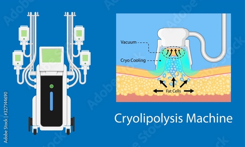 cryolipolysis fat freezing procedure cold treatment non invasive medication reduce temperature break down fat cells removal cosmetic surgery adipose  liposuction Coolsculpting
