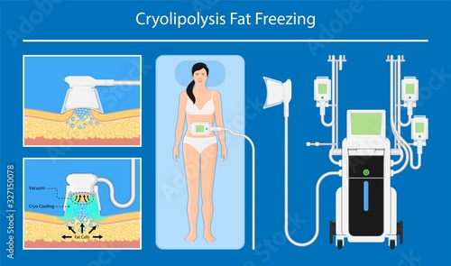 cryolipolysis fat freezing procedure cold treatment non invasive medication reduce temperature break down fat cells removal cosmetic surgery adipose  liposuction Coolsculpting