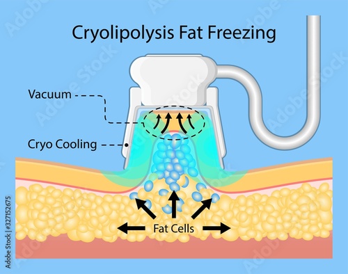 cryolipolysis fat freezing procedure cold treatment non invasive medication reduce temperature break down fat cells removal cosmetic surgery adipose  liposuction Coolsculpting