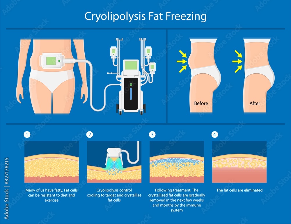 cryolipolysis fat freezing procedure cold treatment non invasive medication reduce temperature