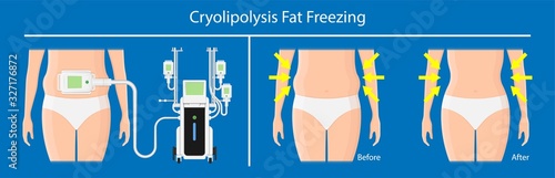 cryolipolysis fat freezing procedure cold treatment non invasive medication reduce temperature break down fat cells removal cosmetic surgery adipose  liposuction Coolsculpting