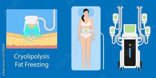cryolipolysis fat freezing procedure cold treatment non invasive medication reduce temperature break down fat cells removal cosmetic surgery adipose  liposuction Coolsculpting