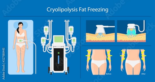 cryolipolysis fat freezing procedure cold treatment non invasive medication reduce temperature break down fat cells removal cosmetic surgery adipose  liposuction Coolsculpting