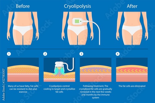 cryolipolysis fat freezing procedure cold treatment non invasive medication reduce temperature break down fat cells removal cosmetic surgery adipose  liposuction Coolsculpting