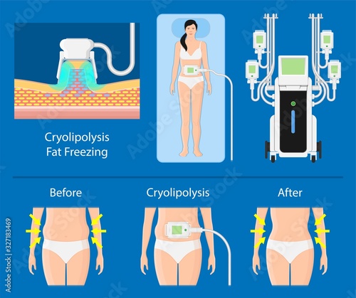 cryolipolysis fat freezing procedure cold treatment non invasive medication reduce temperature break down fat cells removal cosmetic surgery adipose  liposuction Coolsculpting