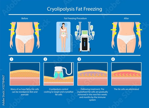 cryolipolysis fat freezing procedure cold treatment non invasive medication reduce temperature break down fat cells removal cosmetic surgery adipose  liposuction Coolsculpting