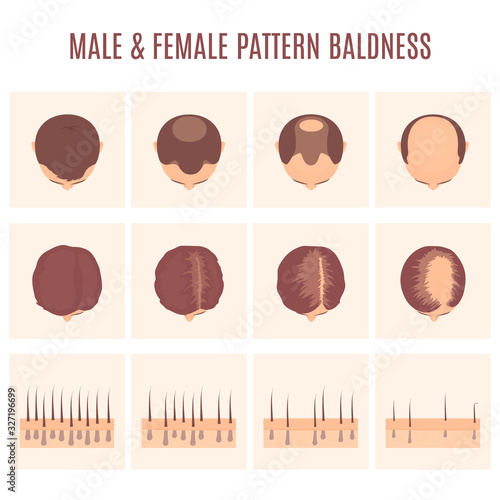 Male and female-pattern hair loss set. Stages of baldness in men and women. Head in top view. Number of follicles on scalp in each step. Alopecia infographic medical vector illustration.