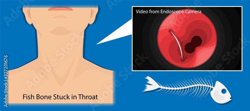 Fish Bone Stuck Throat accidental ingestion painful difficulty swallowing