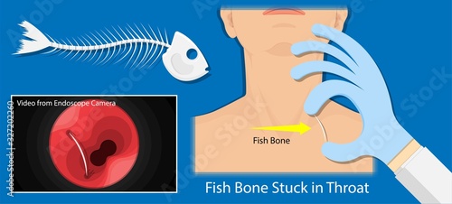 Fish Bone Stuck Throat accidental ingestion painful difficulty swallowing