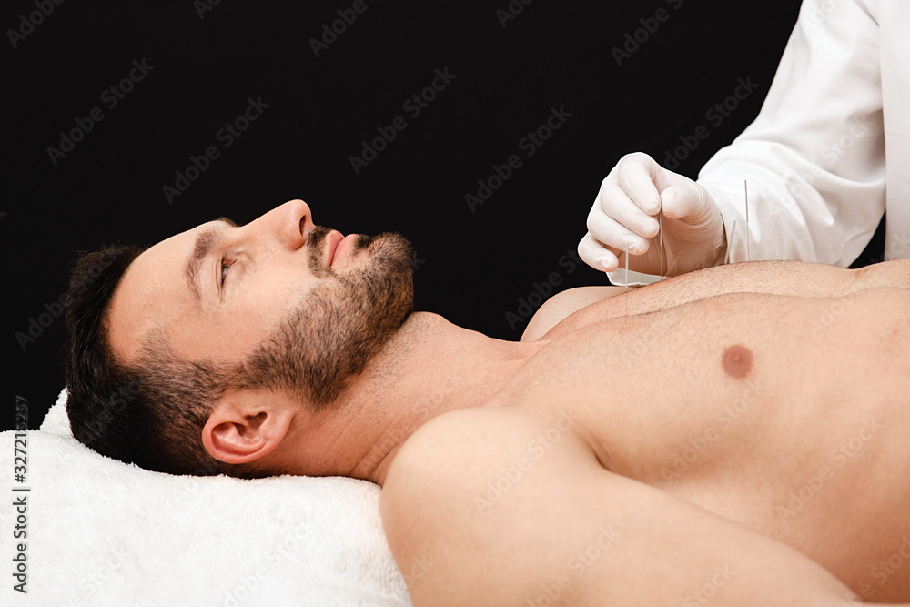Acupuncturist inserts acupuncture needles at special points on the meridians of a man’s body. Acupuncture needles in reflexologist hand close up on black background Acupuncturist inserts acupuncture needles at special points on the meridians of a man’s body. Acupuncture needles in reflexologist hand close up on black background