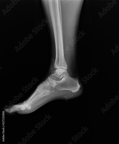 x- ray of the ankle joint in the lateral projection, arthritis, arthrosis