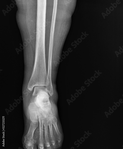 x- ray of the ankle joint in the frontal projection  arthritis  arthrosis