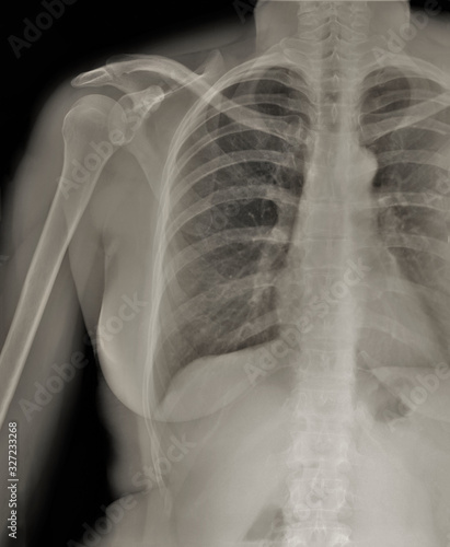 chest x-ray, diagnosis of coronavirus pneumonia