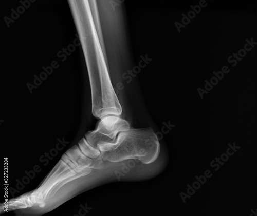 x- ray of the ankle joint in the lateral projection, arthritis, arthrosis