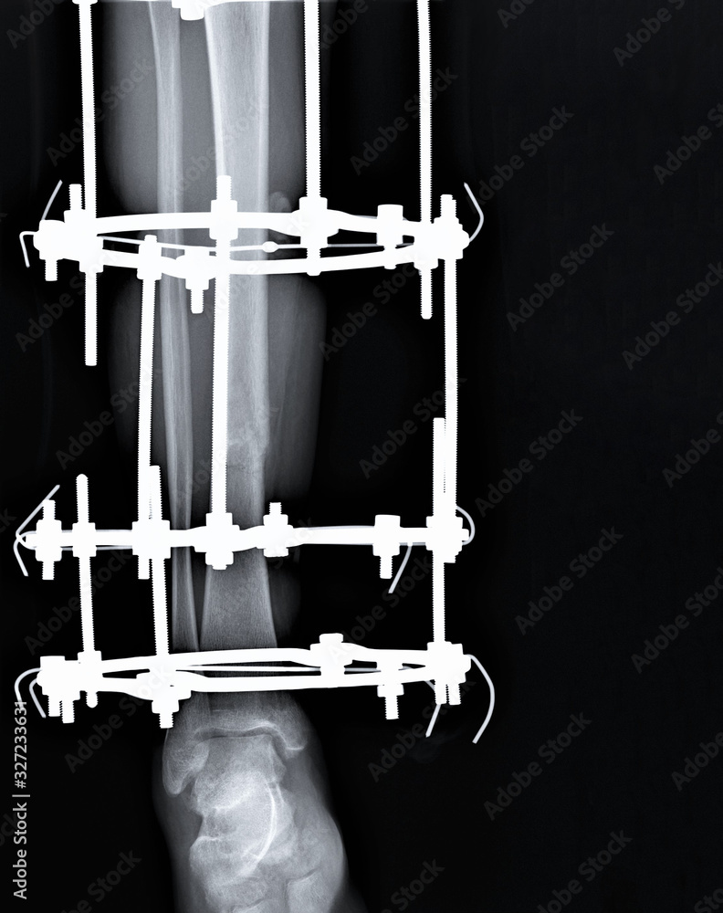x- ray with a fracture of the Shin bones fixed by a metal structure x- ray with a fracture of the Shin bones fixed by a metal structure