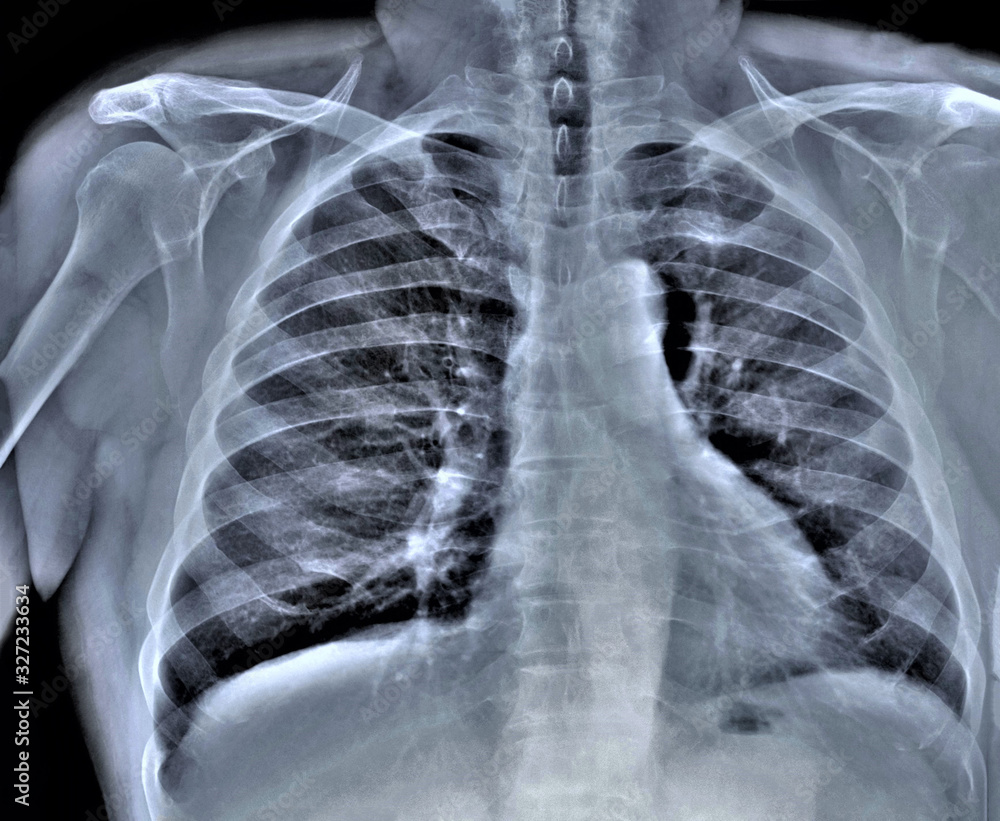 chest x-ray, diagnosis of coronavirus pneumonia chest x-ray, diagnosis of coronavirus pneumonia